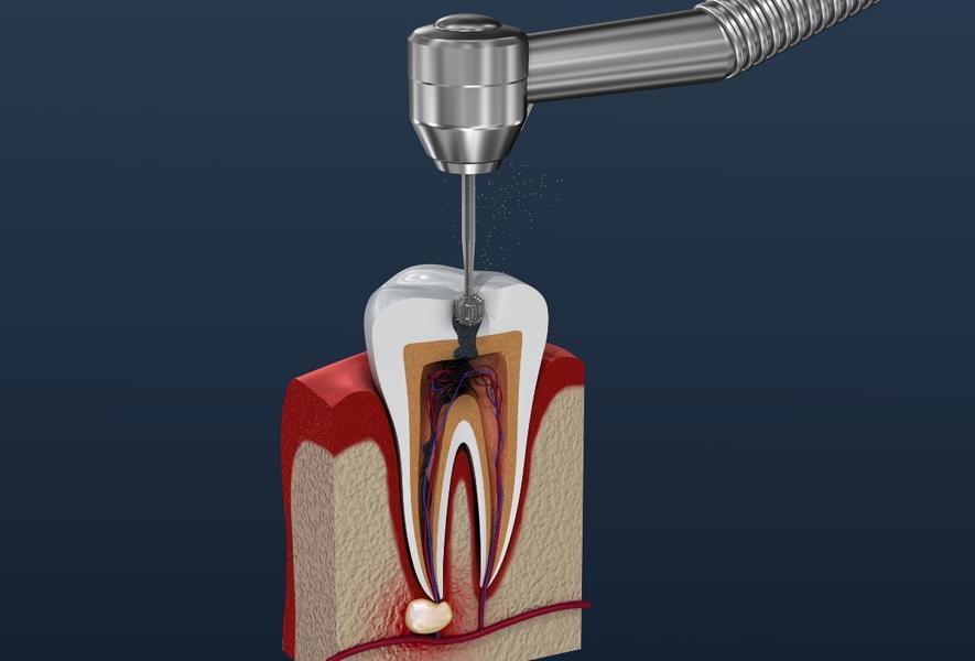 Endodoncie