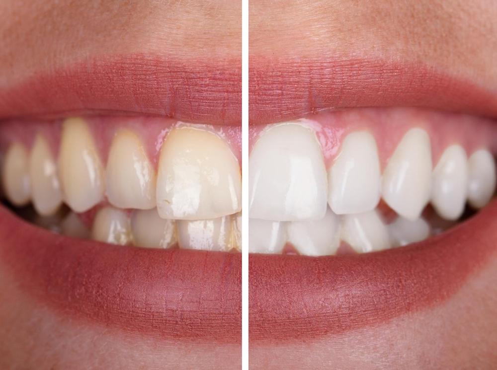 Bělení zubů Dent Vita